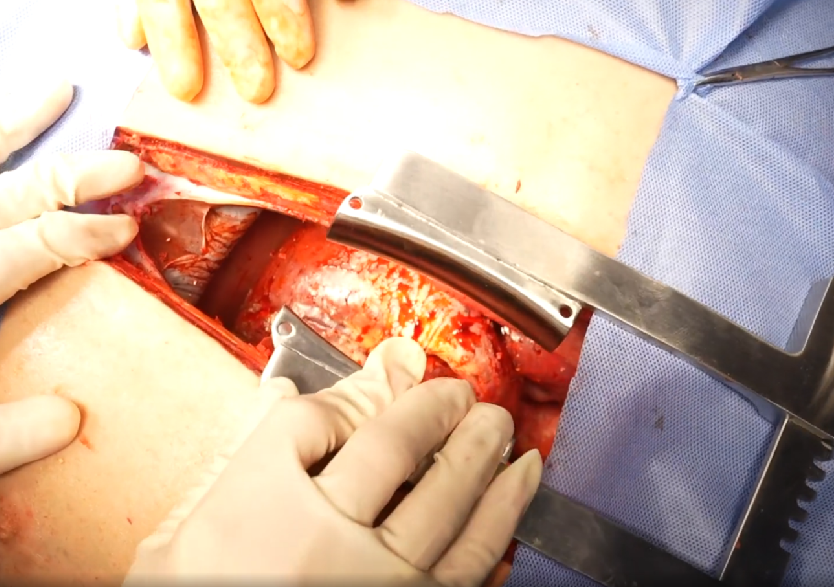 胸腹部損傷控制手術(shù)模擬人系統(tǒng)3.0